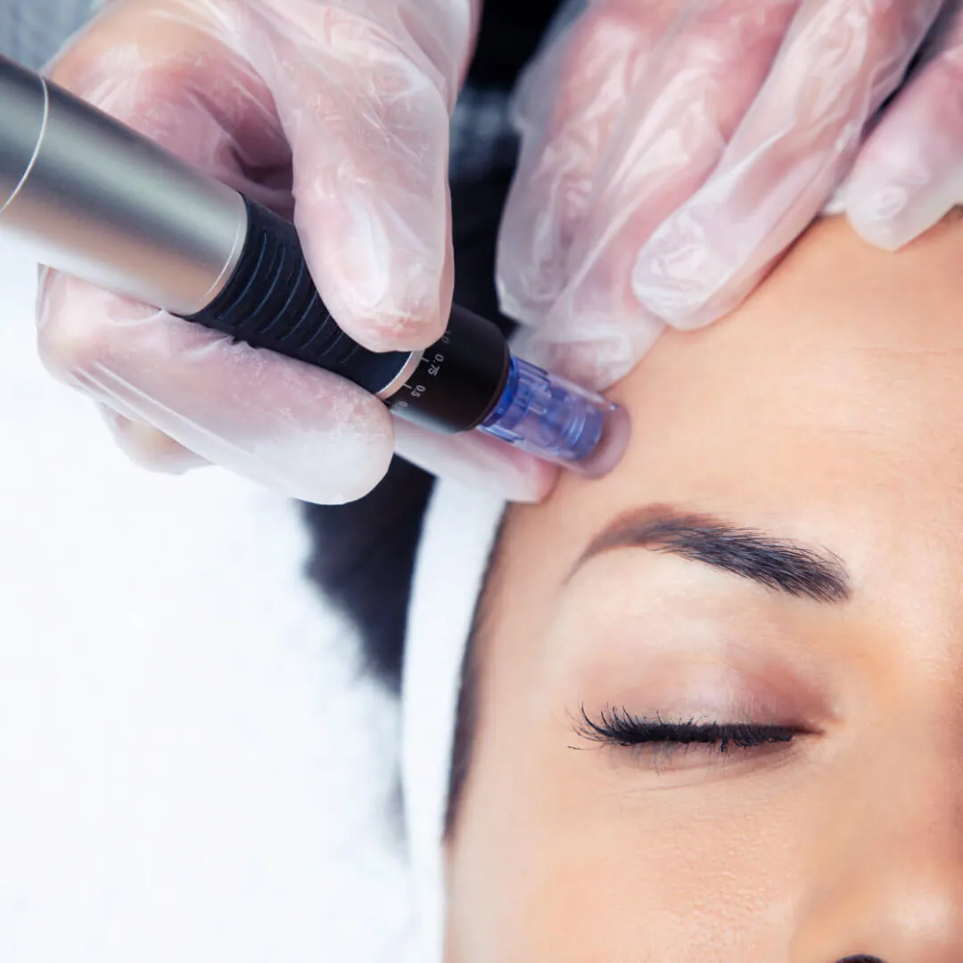 Microneedling-Behandlung mit dem DermaPEN